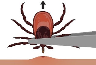Using the tweezers pull the tick upward with steady even pressure